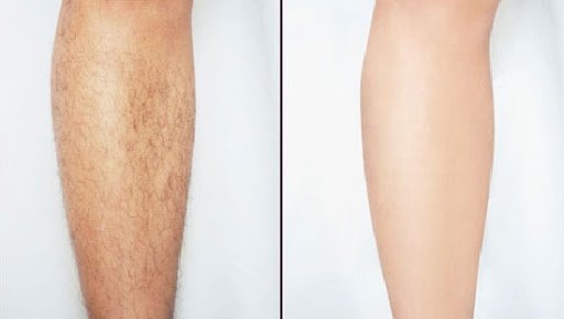 So sánh trước và sau khi triệt lông chân
